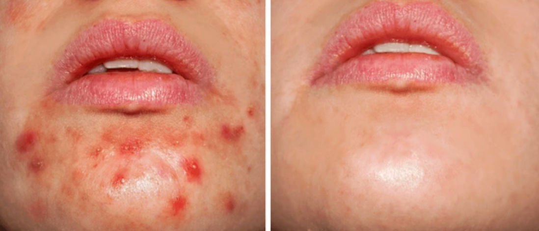 Mejoras de acne cutanea